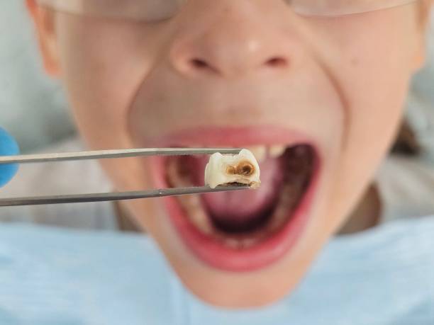 Best Emergency Wisdom Teeth Removal in Spencerville, NM
