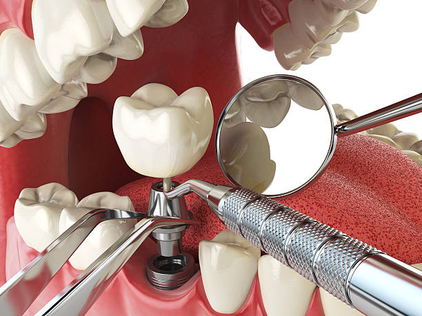 Best Emergency Denture Repair in Spencerville, NM